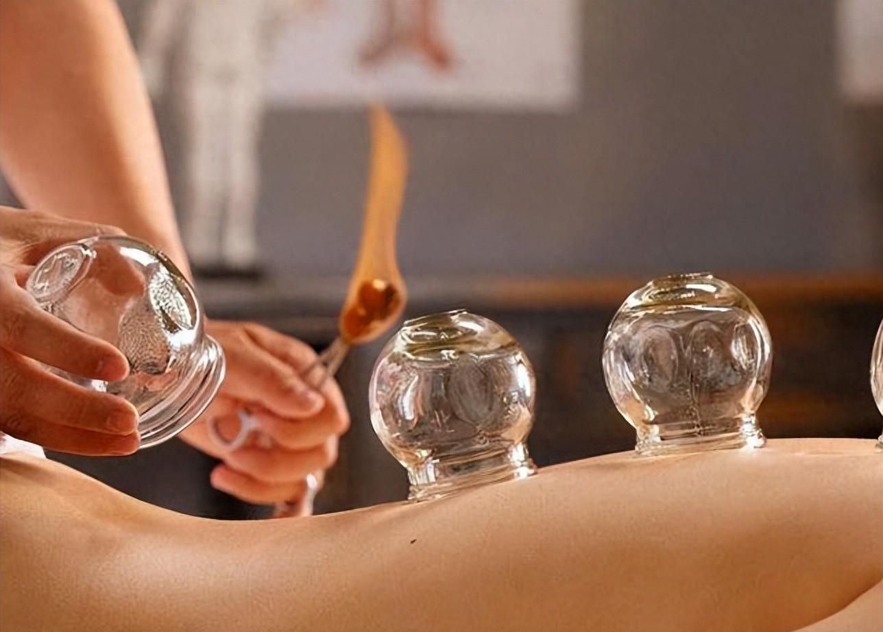  Cupping-Induced Bruises: Are They Really Toxins?
